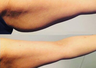 LIpocontrast Duo before and after arms pic