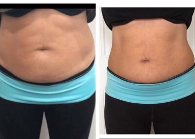 LipoContrast Duo before and after tummy belly abdomen 1