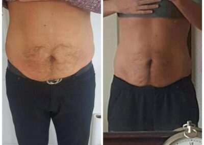 LipoContrast Duo fat loss treatment for men on tummy and belly before and after pic