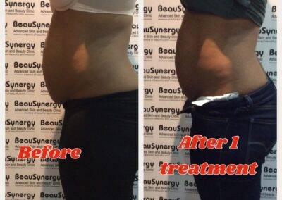 LipoContrast Duo fat loss treatment for tummy and belly before and after pic 2