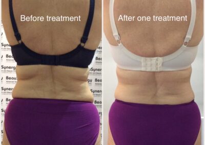 LipoContrast Duo fat loss treatment for tummy and belly before and after pic 3