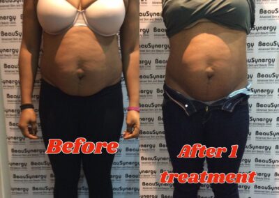 LipoContrast Duo fat loss treatment for tummy and belly before and after pic