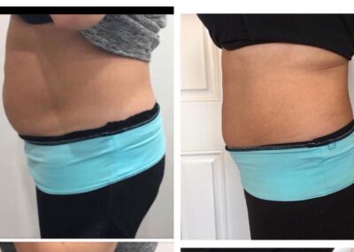 LipoContrast duo before and after tummy belly abdomen 2