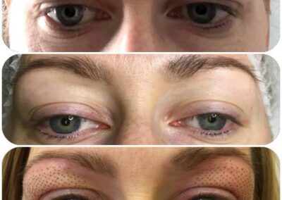 Plasma Pen Eyelid before and after 1
