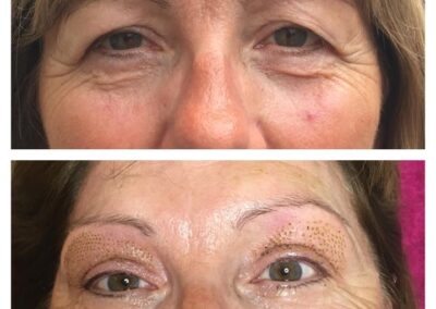 Plasma Pen eye lift before and after