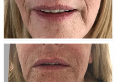 Plasma Pen full mouth area before and 3 days after treatment 1