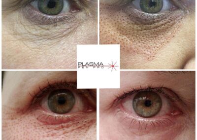 Plasma Pen pro eyebag and wrinkles before and after