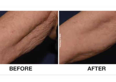 Profhilo before and after elbow for main page. I would like to get the keywords for ageing elbows loose skin on elbows etc