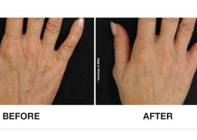 Profhilo before and after hands for main page. I would like to get the keywords treatment for ageing hands or more