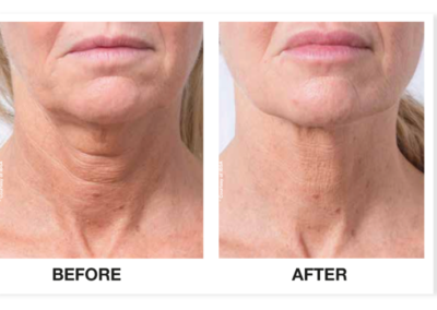 Profhilo before and after neck to go on main page. Keywords for saggy neck ageing neck loose skin on neck etc