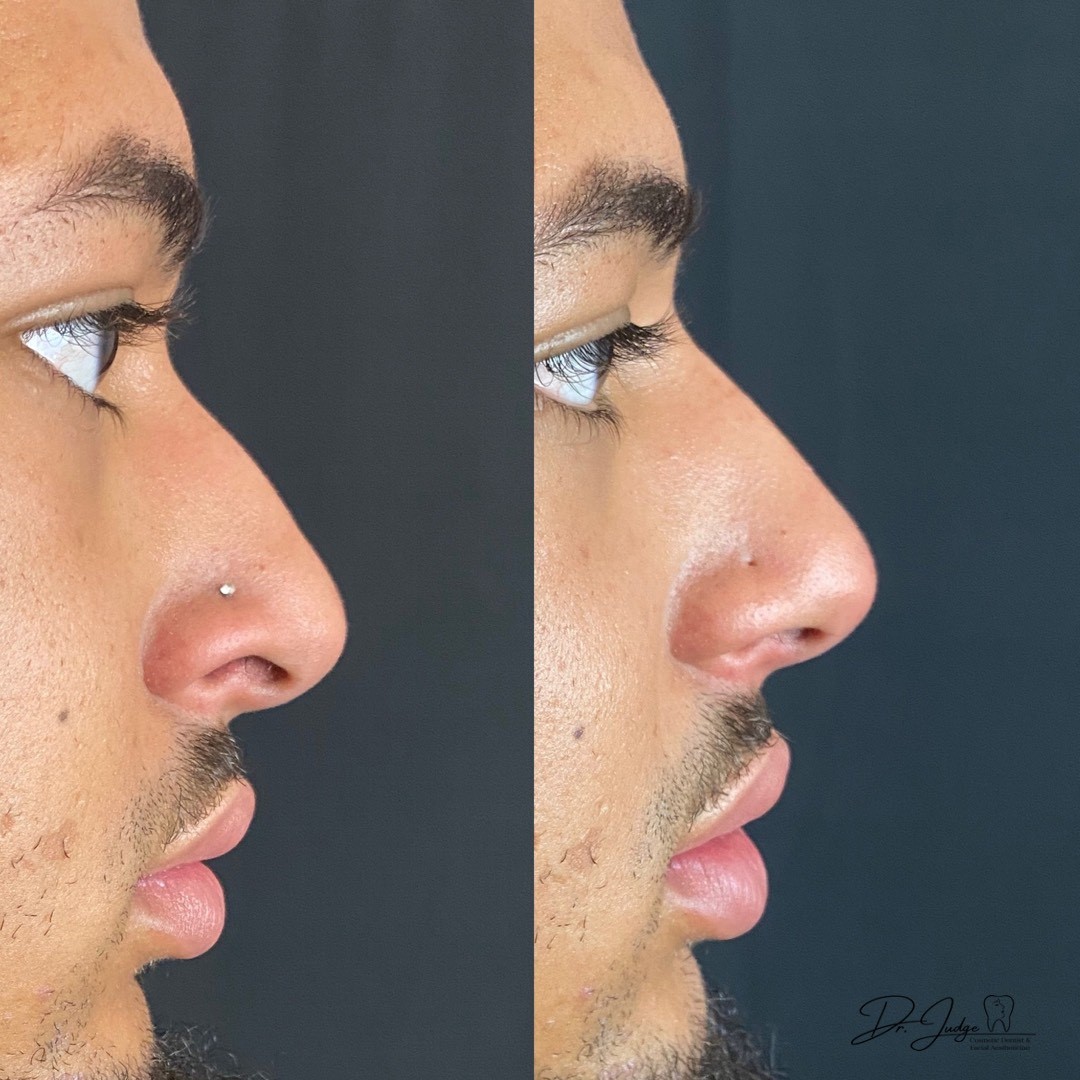 Rhinoplasty hooked roman nose before and after