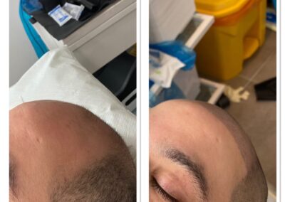 Scalp micropigmentation hair loss baldness