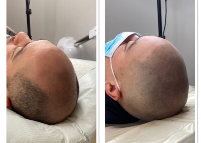 Scalp micropigmentation hair loss baldness treatment 2