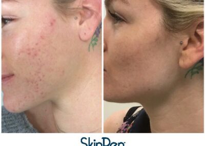 Skin Pen acne scar before and after 3