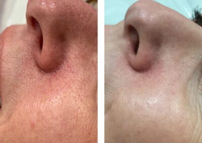 Thread Vein removal with Thermavein around nose
