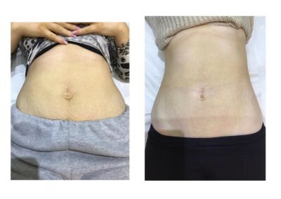 Venus Freeze skin tightening on tummy belly before and after 1