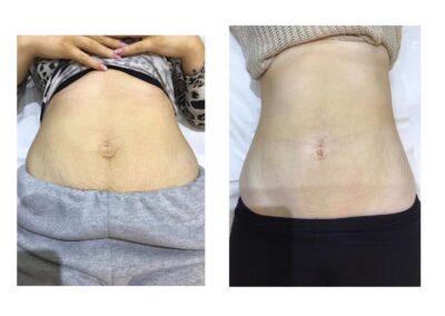 Venus Freeze skin tightening on tummy belly before and after