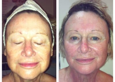 Veus Freeze skin tightening before and after 1