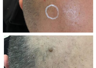 Wart on scalp before and after CryoPen treatment