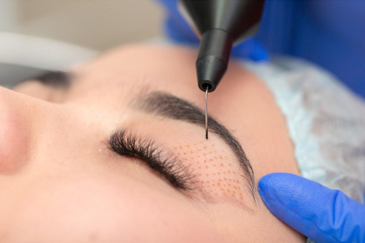 Fibroblast Plasma treatment for non surgical eyelid lift
