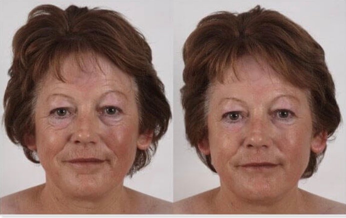 Ultimate non surgical face lift